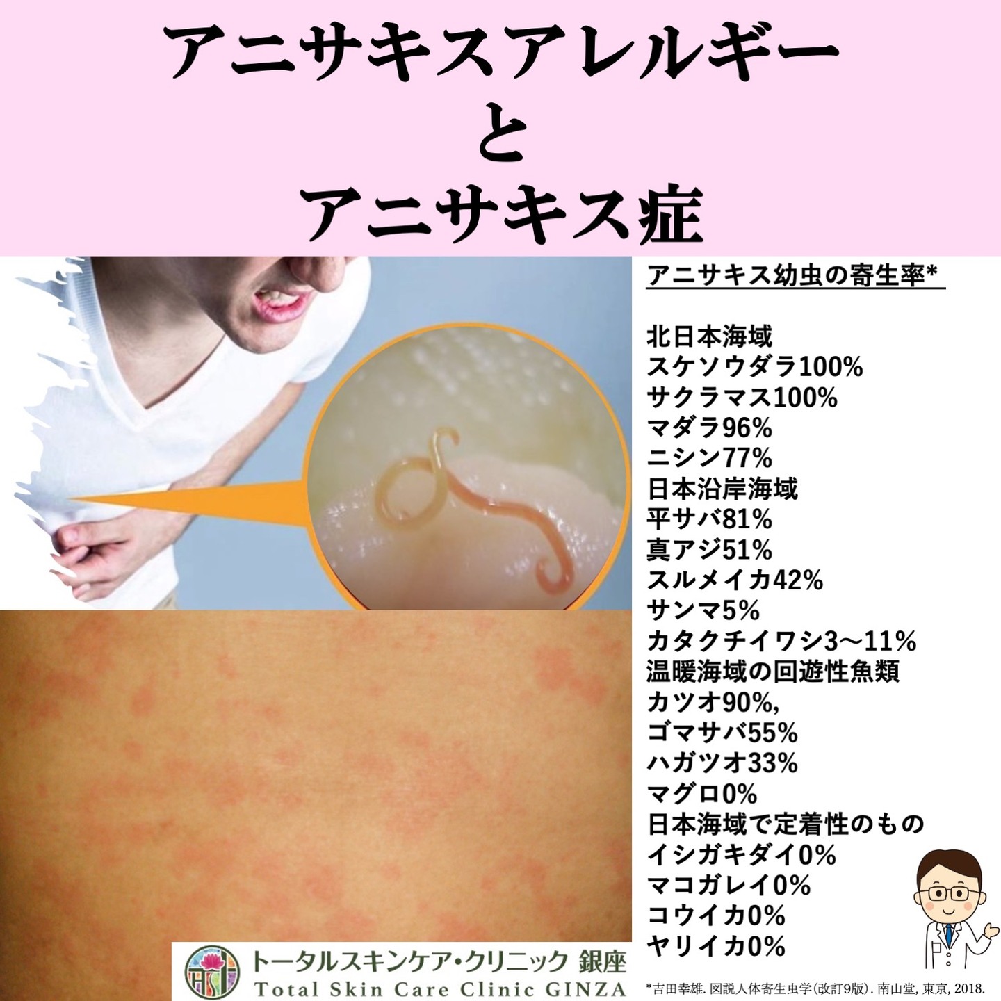 トータルスキンケア・クリニック銀座
魚アレルギーの次は魚に寄生するアニサキスによるアレルギーについてのお話です。
時々アニサキスアレルギーとアニサキス症について混同される方がおられますので簡単に説明します1)。
アニサキス幼虫の寄生率(図)2)
●北日本海域:スケソウダラ100%,サクラマス100%,マダラ96%,ニシン77%
●日本沿岸海域:平サバ81%,真アジ51%,スルメイカ42%,サンマ5%,カタクチイワシ3〜11%
●温暖海域の回遊性魚類:カツオ90%,ゴマサバ55%,ハガツオ33%,マグロ0%
●日本海域で定着性のもの:イシガキダイ0%,マコガレイ0%,コウイカ0%,ヤリイカ0%
アニサキス症:アニサキス第3幼虫症が人体の胃や腸に穿入して激しい胃腸炎を呈する疾患です。本邦では食品媒介寄生虫症の中で最も多く,アニサキス属幼線虫は食品衛生法で食中毒起因物質に指定されています3)。
アニサキスアレルギー:アニサキス幼虫の寄生した魚の摂取後に全身に蕁麻疹や時にアナフィラキシー症状を呈する疾患です。日本人のアニサキスに対する特異的IgE抗体の保有率は26〜52%で年齢と相関して上昇します4)。
魚摂取後にアレルギー症状を呈した45歳以上の症例ではアニサキスアレルギーの可能性が高くなります5)。
現在までにアニサキスのアレルゲンコンポーネントは,Ani s1〜11,Ani s 11-like,Ani s 12〜14,トロポニンCの16種類が同定されています5)。
アニサキスは冷凍(-20℃で24時間以上)や加熱(70度以上または60℃で1分以上)で死滅しますが,一部のアレルギーコンポーネントは残るので注意が必要です5,6)。
アニサキスアレルギーが疑われる方は、クリニックで採血にてアニサキスの特異的IgE抗体を測定できますのでご相談下さい。
院長
1.中野敏明. 改訂第6版 救急診療指針 上巻皮膚科領域. 515-544. 東京, ヘルス出版, 2024
2. 吉田幸雄. 直薗直樹. 図説人体寄生虫学(改訂9版). 南山堂, 東京, 2018.
3. 鈴木 淳,村田理恵. 東京健安研セ年報. 62; 13-24, 2011.
4. 梅林芳弘. アレルギー. 50; 1090-1095, 2001.
5. 千貫祐子,森田栄伸. MB Derma. 307; 13-19, 2021.
6. 食品安全委員会(内閣府). アニサキス症(概要). ファクトシート. 2023年3月閲覧可能. https://www.fsc.go.jp/factsheets/index.data/factsheets_anisakidae.pdf
#東銀座 #築地 #トータルスキンケアクリニック銀座 #東銀座皮ふ科 #銀座松竹スクエア #聖路加 #聖路加国際病院 #皮膚科 #クリニック #アニサキスアレルギー #アニサキス症 #アナフィラキシー #魚アレルギー #蕁麻疹 #寿司 #魚