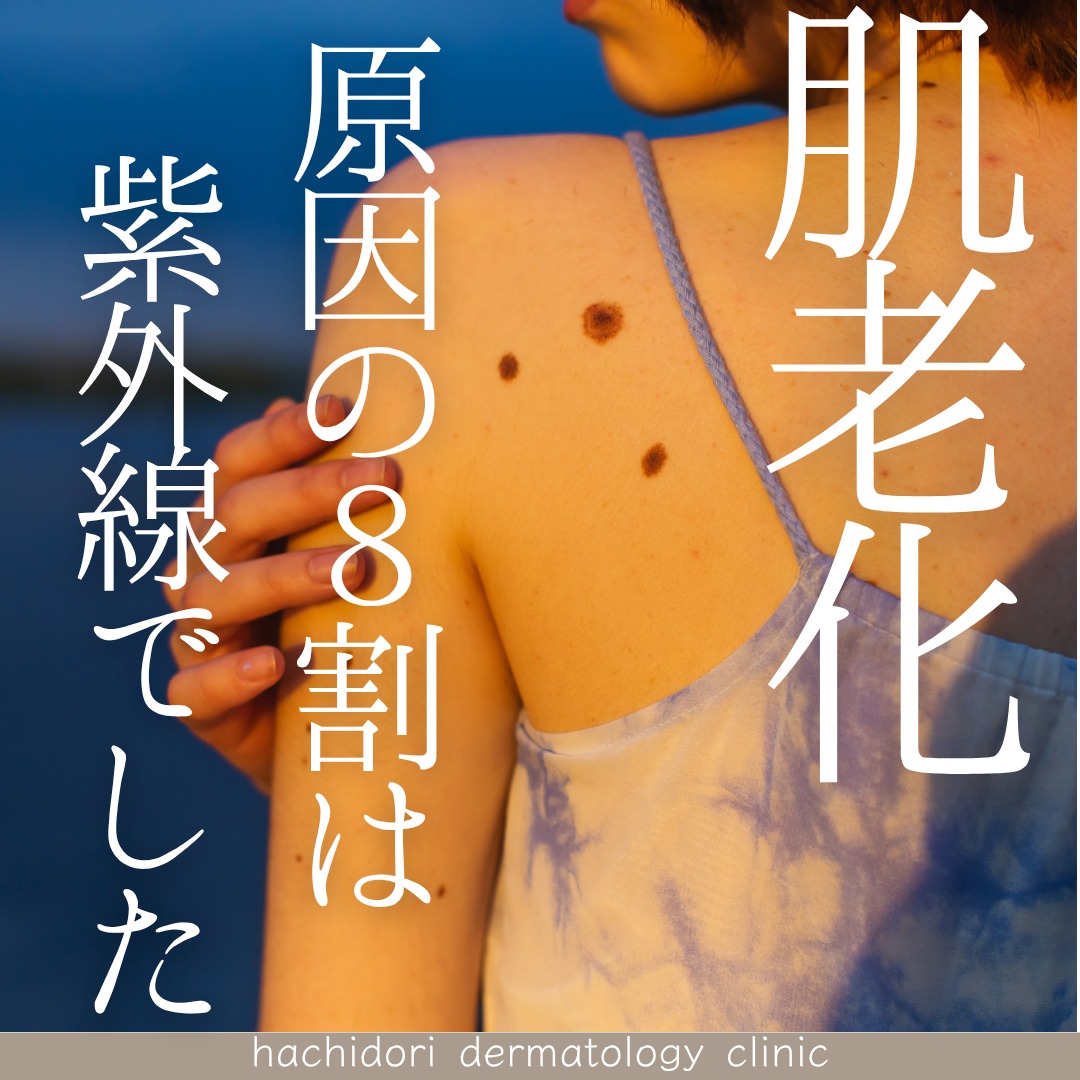 「最近、シミや小じわ、たるみが気になってきたな…」 そう感じることはありませんか?😢
実は、肌が年齢とともに衰える原因の 【約80%】は加齢ではなく「紫外線(光老化)」によるものだと、 米国皮膚科学会でも指摘されているんです!⚠️
つまり、正しい紫外線対策を徹底することが、 未来の美肌を守る最大のエイジングケアになります✨
🧐 知っておきたい紫外線の基本
地表に届く紫外線には、肌の奥まで届いてじわじわとたるみを引き起こす「UV-A」と、肌の表面にダメージを与えてシミや赤みの原因になる「UV-B」の2種類があります。
日焼け止めに書かれている
PA(+の数)➔ UV-Aを防ぐ効果の指標
SPF(数値) ➔ UV-Bを防ぐ効果の指標 を、毎日のシーンに合わせて選ぶことが大切です💡
🩺 当院おすすめの日焼け止め3選
当院では、レーザー治療後やデリケートなお肌の方でも安心して使える、実力派アイテムを厳選して取り扱っております🛒
01. NAVISION(ナビジョン)TAホワイトプロテクトUV
価格:¥4,400(税込)/ SPF50・PA+++
徹底的に「守る」と、美白成分(トラネキサム酸・4MSK)で「攻める」を両立した欲張りUV。みずみずしい使用感でスタッフにも大人気です!
02. NAVISION(ナビジョン)TAマイルドプロテクトUV
価格:¥3,940(税込)/ SPF40・PA+++
紫外線吸収剤フリーのノンケミカル処方。敏感肌の方にも安心。石けんで落とせるため、毎日の肌負担を最小限に抑えたい方に最適です。
03. Beautiful Skin(ビューティフルスキン)ノンUVミネラルパウダー
価格:¥4,400(税込)/ SPF50・PA+++
全成分わずか「4つのミネラル」のみで作られた究極のシンプルパウダー。メイクの上からの塗り直しや、日中のベタつき抑えにも。
「自分の肌質にはどれが合う?」「今の時期はどれを選ぶべき?」など、迷われた際はお気軽にクリニックスタッフまでご相談ください☺️
これからの季節、紫外線に負けない透明感のあるお肌を一緒に作っていきましょう!
みなさまのご来院を心よりお待ちしております✨
____________________
🗓️休診日
日・月・祝
土曜日は午前診療のみ
▼予約方法
HPからご予約お願いいたします😌🌷
プロフィールのリンクよりHPへのアクセスが可能です。
┈┈┈┈┈┈┈┈┈┈┈┈┈┈┈┈┈┈┈┈┈┈
📍はちどり皮膚科
枚方市新町1丁目1-1
そうごうメディカルモール枚方市駅前2F
🚊枚方市駅東改札口より徒歩すぐ
🕒診療時間
平日 10:00-13:00
15:00-18:45
土曜 10:00-13:00
休診日 日・月・祝
┈┈┈┈┈┈┈┈┈┈┈┈┈┈┈┈┈┈┈┈┈┈
#皮膚科 #美容皮膚科 #光老化 #紫外線対策 #日焼け止め #ナビジョン #ナビジョンdr #ビューティフルスキン #ノンuvミネラルパウダー #シミ対策 #美白ケア #敏感肌スキンケア #エイジングケア