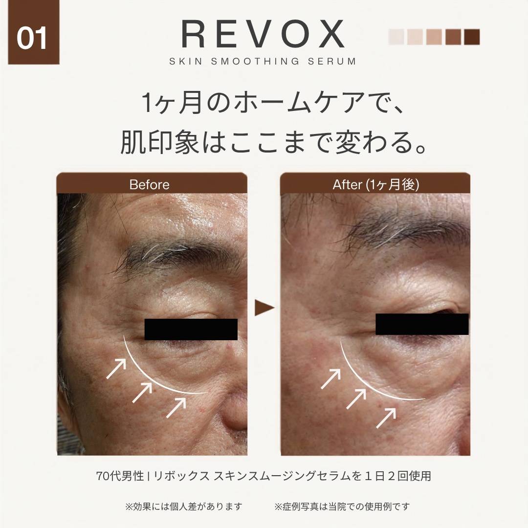 ✨【塗るだけで、表情ジワをなめらかに。】✨
笑ったときの目元のシワ、眉間や額の表情ジワが気になる方へ💭
今回ご紹介するのは、Revision Skincare(リビジョンスキンケア)の
「Revox™ Skin Smoothing Serum(リボックス スキンスムージングセラム)」🧴✨
リボックスには、アセチルオクタペプチド-3など複数のペプチドが配合されており、表情の動きによって目立ちやすいラインに着目した美容液です。
さらに、ヒアルロン酸やイヌリンなどの保湿成分も配合💧
肌にうるおいを与え、乾燥による小ジワを目立ちにくくし、なめらかな印象へ導きます✨
🌿【こんな方におすすめ】
✔️ 目元や額などの小ジワが気になる
✔️ 笑ったときの目尻や頬のラインが気になる
✔️ ボトックスを打つのは怖いけれど、小ジワのケアをしたい
✔️ ボトックス治療とあわせてホームケアも取り入れたい
✔️ ハリのある、なめらかな肌質を目指したい
💉【ボトックスとの併用もおすすめ】
リボックスは、ボトックス注射そのものと同じ作用をするものではありません。
ボトックス治療と適切なスキンケアを組み合わせることで、それぞれ異なるアプローチから表情ジワのケアを行うことができます✨
「自分のシワにはどんな治療・スキンケアが合う?🤔」
という方は、お気軽にご相談ください🌿
※効果・使用感には個人差があります。
____________________
🗓️休診日
日・月・祝
土曜日は午前診療のみ
▼予約方法
HPからご予約お願いいたします😌🌷
プロフィールのリンクよりHPへのアクセスが可能です。
┈┈┈┈┈┈┈┈┈┈┈┈┈┈┈┈┈┈┈┈┈┈
📍はちどり皮膚科
枚方市新町1丁目1-1
そうごうメディカルモール枚方市駅前2F
🚊枚方市駅東改札口より徒歩すぐ
🕒診療時間
平日 10:00-13:00
14:20-18:45
土曜 10:00-13:00
休診日 日・月・祝
┈┈┈┈┈┈┈┈┈┈┈┈┈┈┈┈┈┈┈┈┈┈
#大阪皮膚科
#枚方市皮膚科
#はちどり皮膚科
#リボックス
#リボックススキンスムージングセラム
#リビジョンスキンケア
#RevisionSkincare
#表情ジワ
#目元のシワ
#目尻のシワ
#眉間のシワ
#額のシワ
#ペプチド美容液
#ボトックス
#ボトックス治療
#美容皮膚科
#ドクターズコスメ